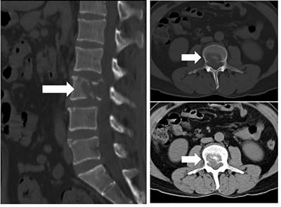 A case report of primary cardiac angiosarcoma with DNMT3A gene mutation
